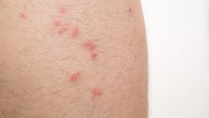how to treat flea bites